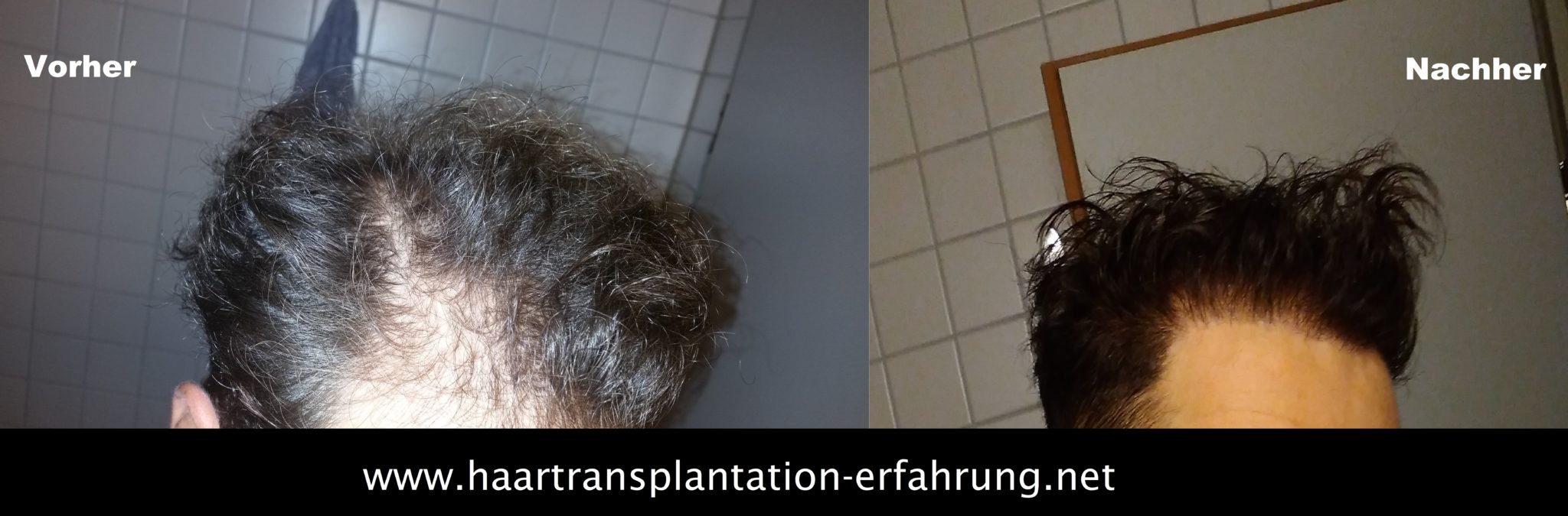 Haartransplantation Vorher Nachher